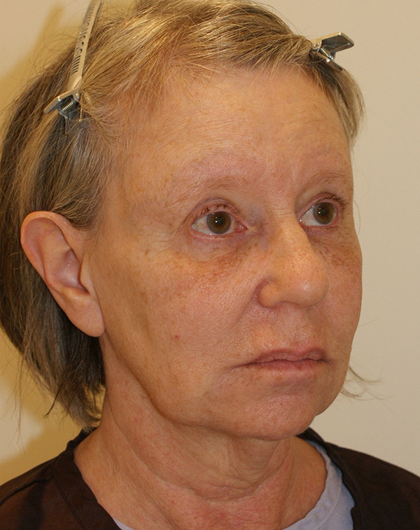 Photo of Patient 14 Before Face And Neck Lift Procedure