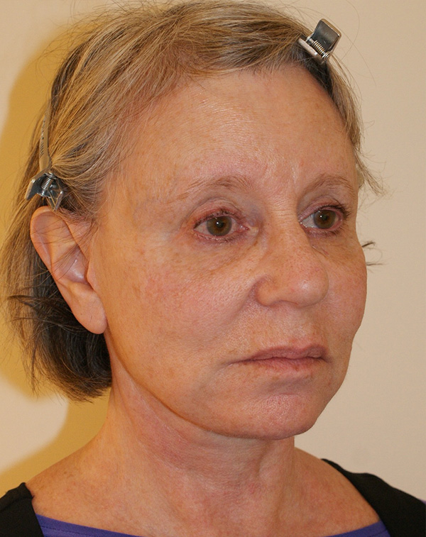 Photo of Patient 14 After Face And Neck Lift Procedure