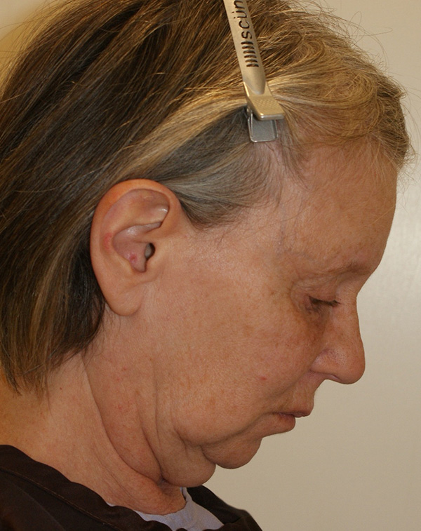 Photo of Patient 14 Before Face And Neck Lift Procedure