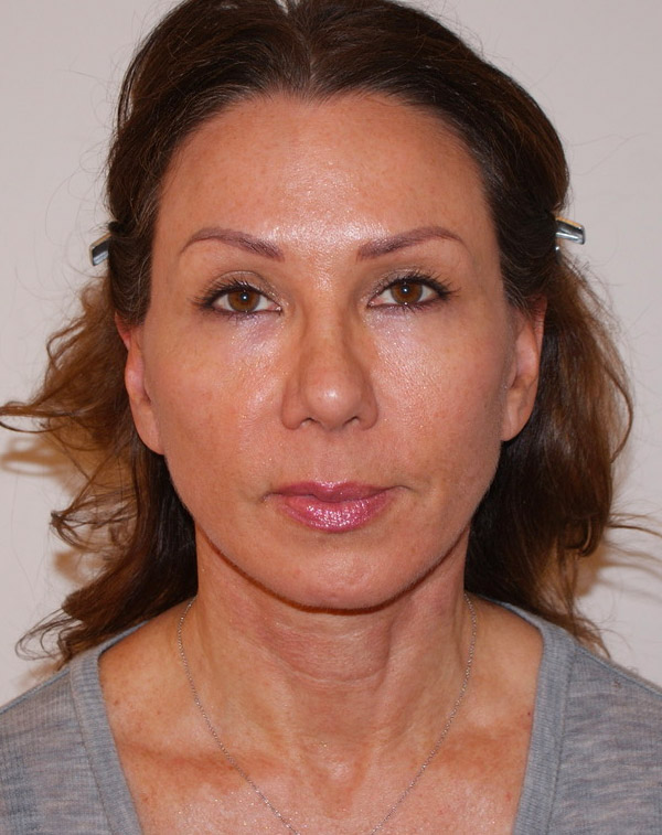 Photo of Patient 15 After Face And Neck Lift Procedure