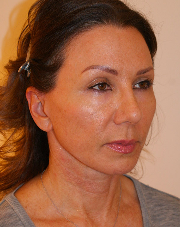 Photo of Patient 15 After Face And Neck Lift Procedure