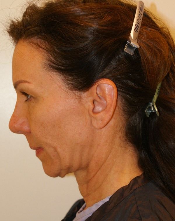 Photo of Patient 15 Before Face And Neck Lift Procedure
