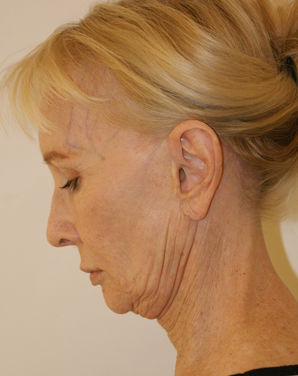 Photo of Patient 15 Before Face And Neck Lift Procedure