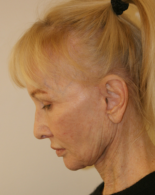 Photo of Patient 15 After Face And Neck Lift Procedure