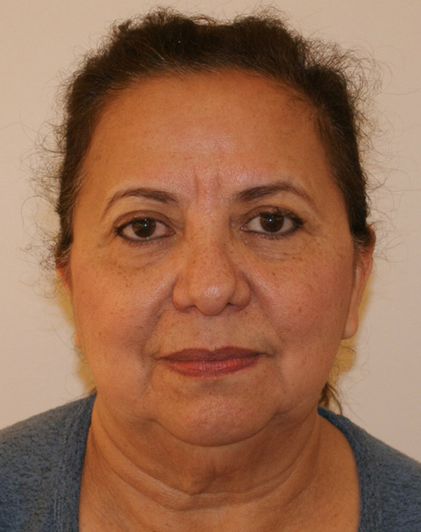 Photo of Patient 16 Before Face And Neck Lift Procedure