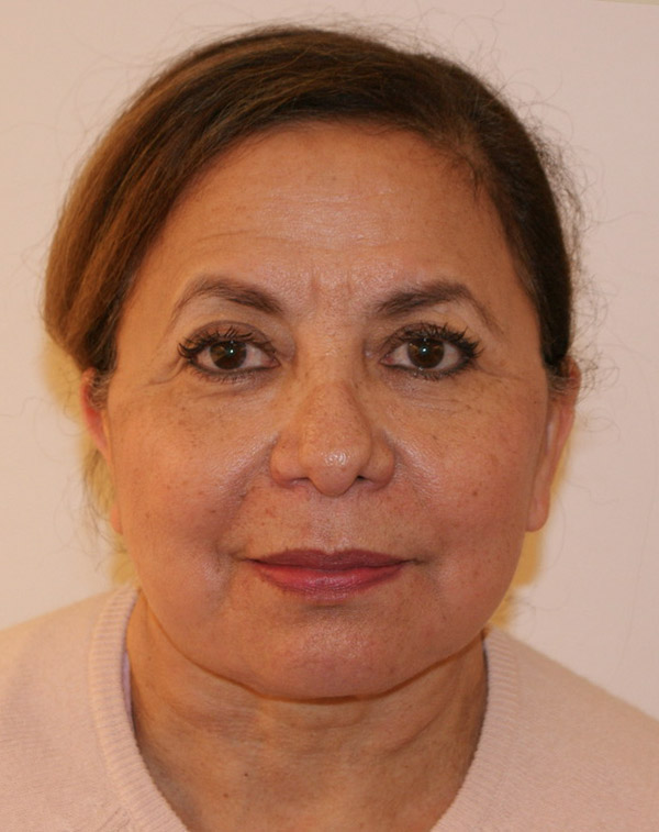Photo of Patient 16 After Face And Neck Lift Procedure