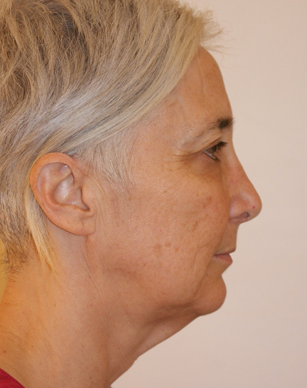 Photo of Patient 17 Before Face And Neck Lift Procedure