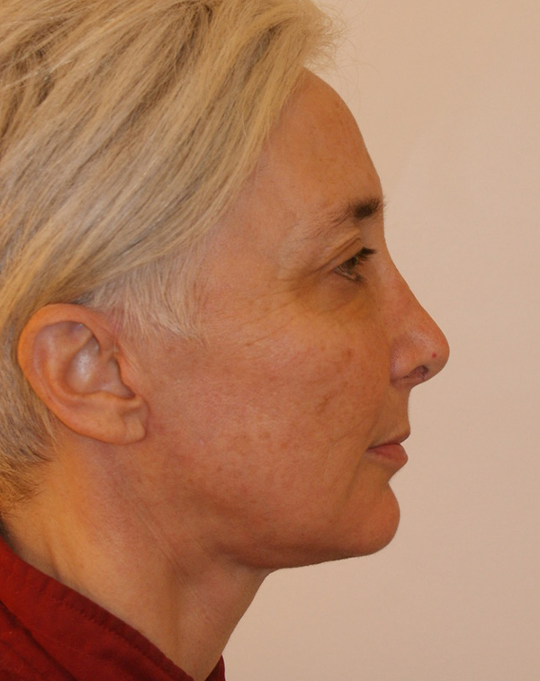 Photo of Patient 17 After Face And Neck Lift Procedure