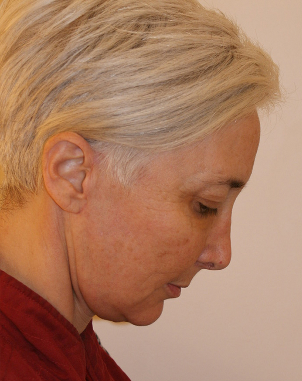 Photo of Patient 17 After Face And Neck Lift Procedure
