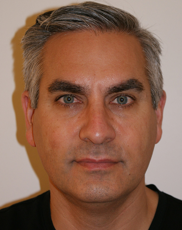 Face And Neck Lift Before and After | Dino Elyassnia, MD