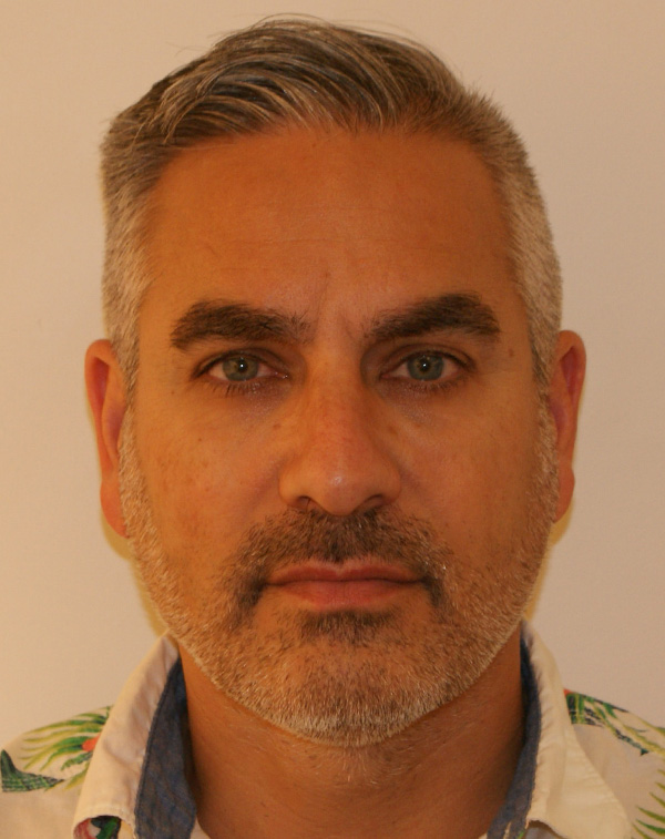 Face And Neck Lift Gallery Patient 18