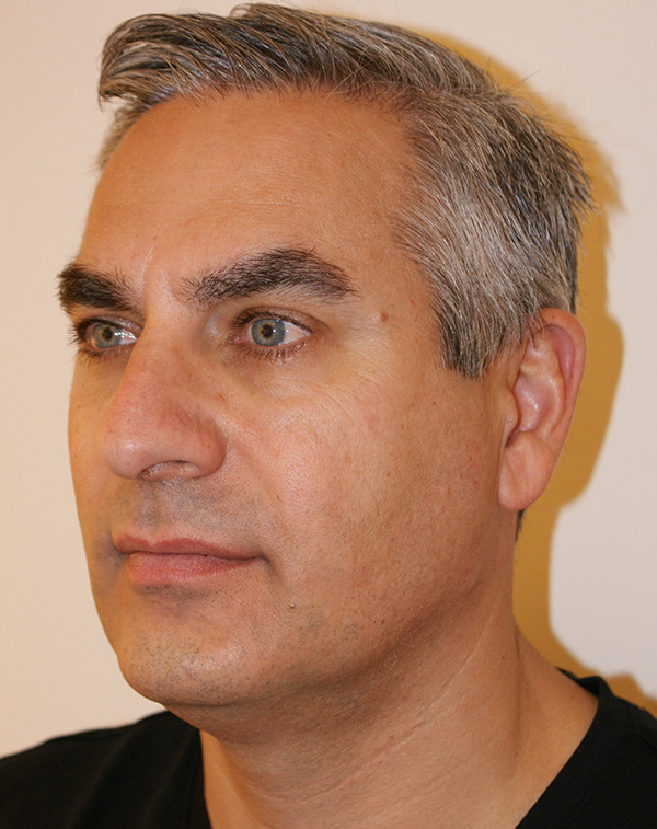 Photo of Patient 18 Before Face And Neck Lift Procedure