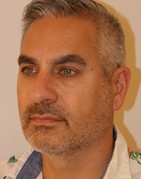 Photo of Patient 18 After Face And Neck Lift Procedure