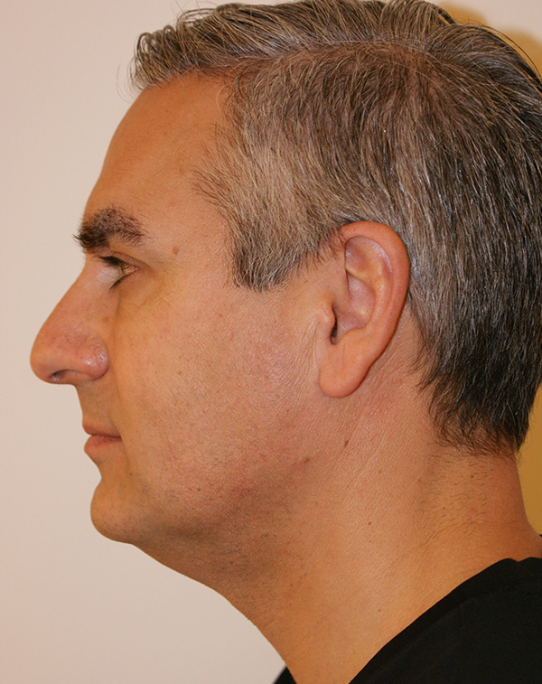 Photo of Patient 18 Before Face And Neck Lift Procedure