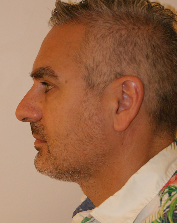 Photo of Patient 18 After Face And Neck Lift Procedure