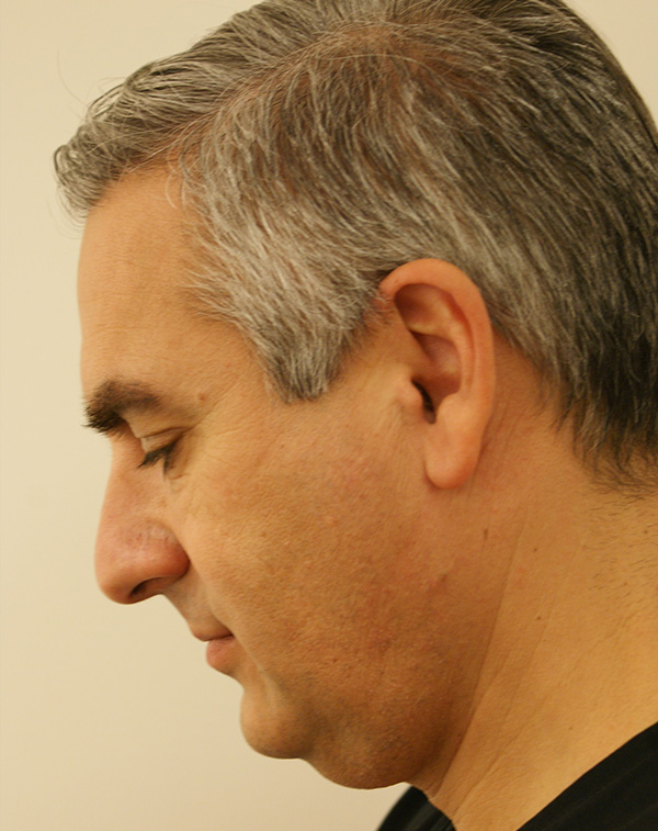 Photo of Patient 18 Before Face And Neck Lift Procedure