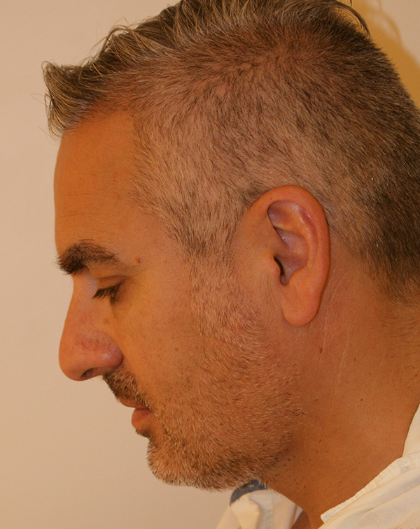 Photo of Patient 18 After Face And Neck Lift Procedure