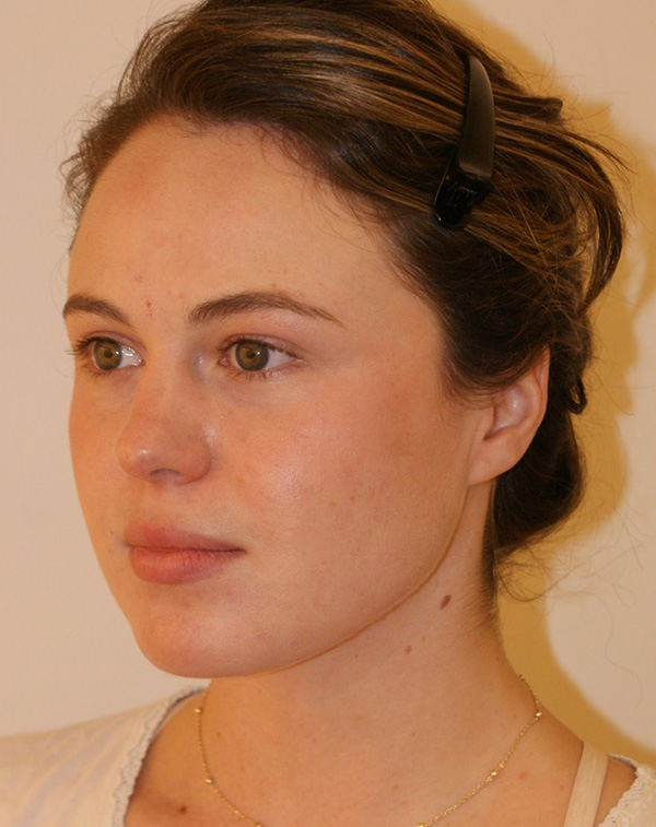 Face And Neck Lift Gallery Patient 19