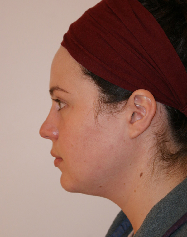 Photo of Patient 19 Before Face And Neck Lift Procedure