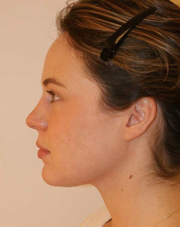 Photo of Patient 19 After Face And Neck Lift Procedure