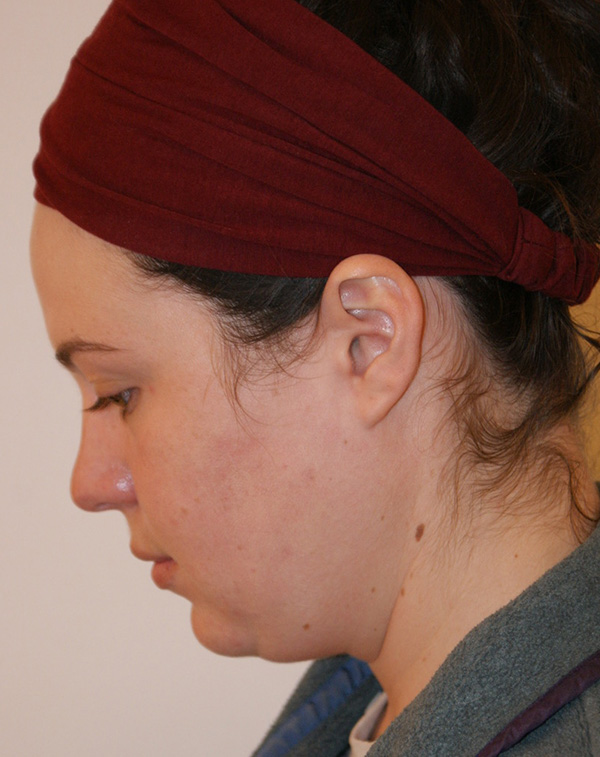 Photo of Patient 19 Before Face And Neck Lift Procedure