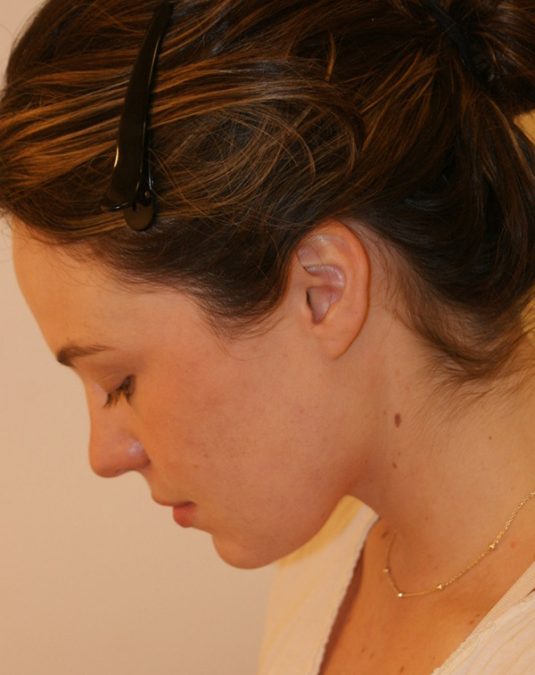 Photo of Patient 19 After Face And Neck Lift Procedure