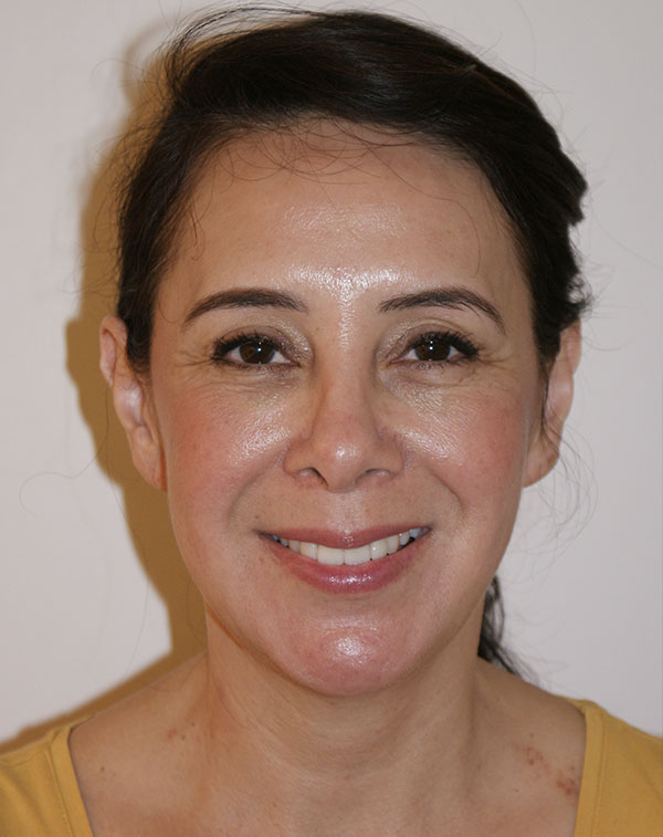 Photo of Patient 20 Before Face And Neck Lift Procedure