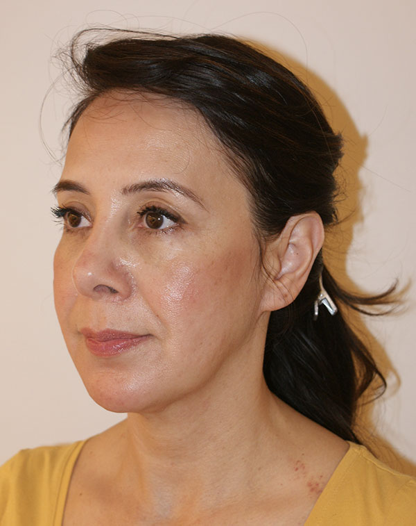 Photo of Patient 20 Before Face And Neck Lift Procedure