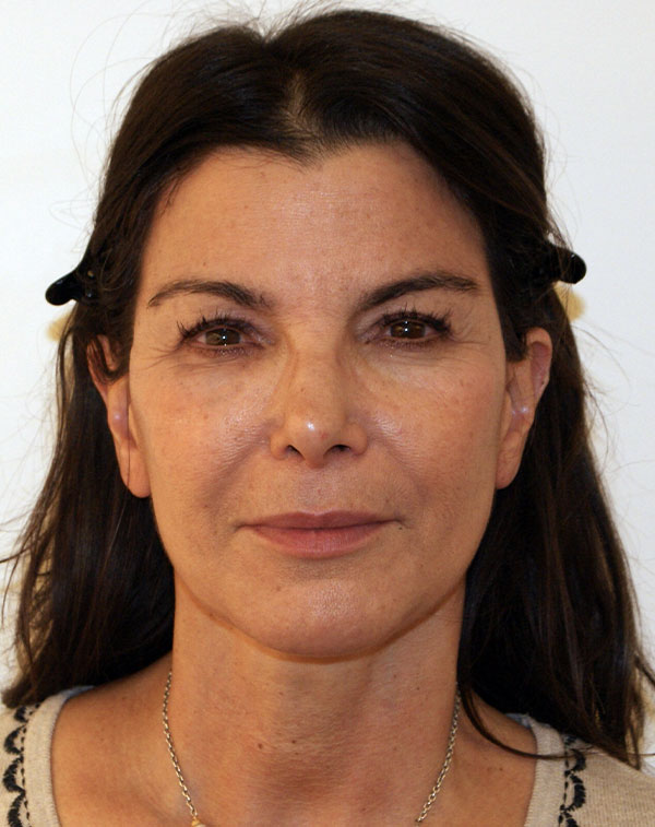 Face And Neck Lift Gallery Patient 21