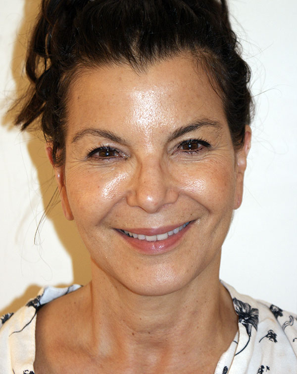 Photo of Patient 21 Before Face And Neck Lift Procedure