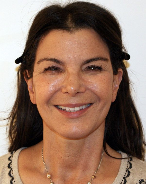 Photo of Patient 21 After Face And Neck Lift Procedure