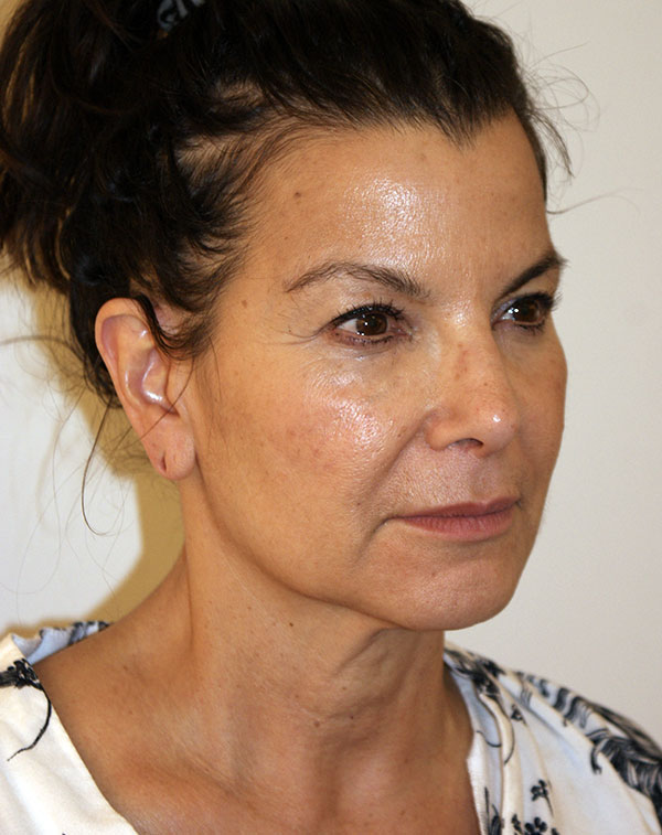 Photo of Patient 21 Before Face And Neck Lift Procedure