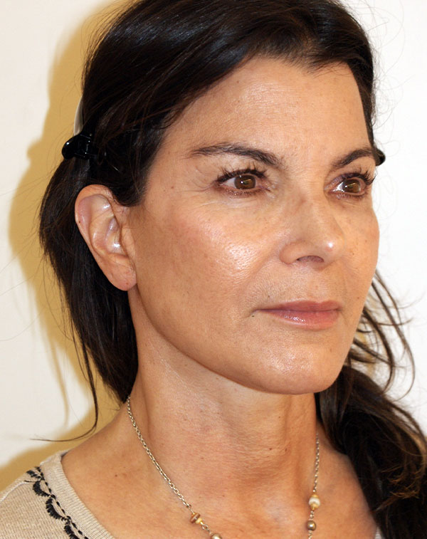 Photo of Patient 21 After Face And Neck Lift Procedure