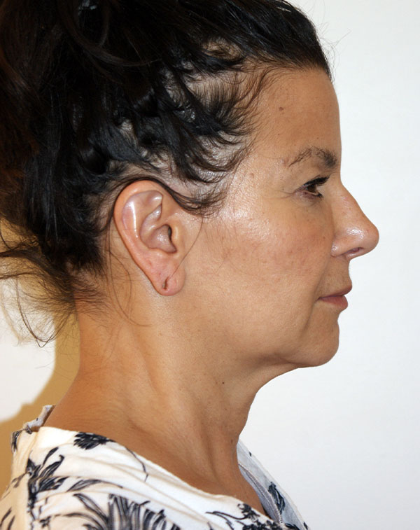Photo of Patient 21 Before Face And Neck Lift Procedure