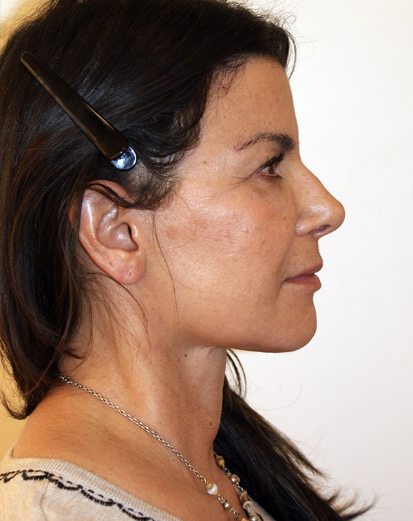 Photo of Patient 21 After Face And Neck Lift Procedure