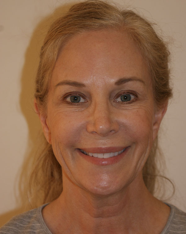 Photo of Patient 22 Before Face And Neck Lift Procedure