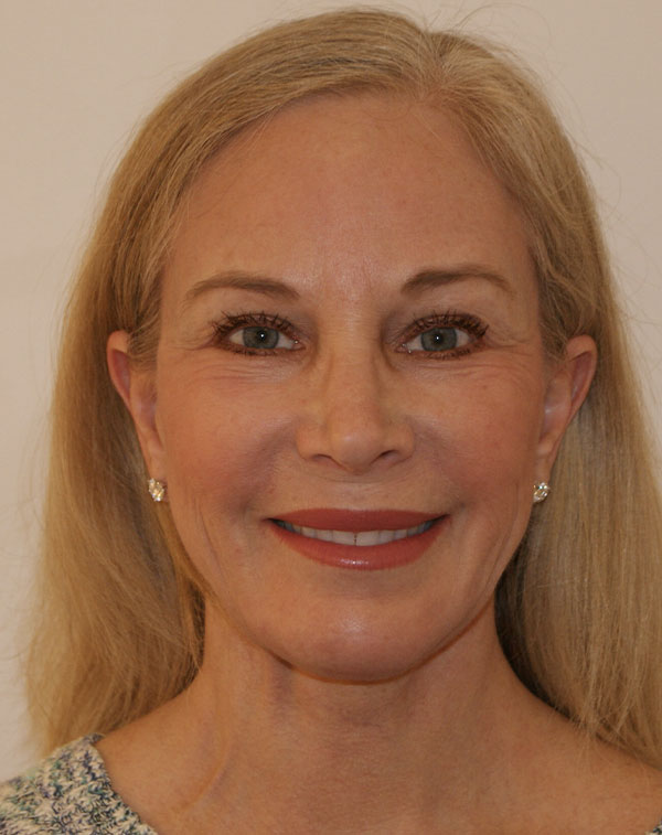 Photo of Patient 22 After Face And Neck Lift Procedure