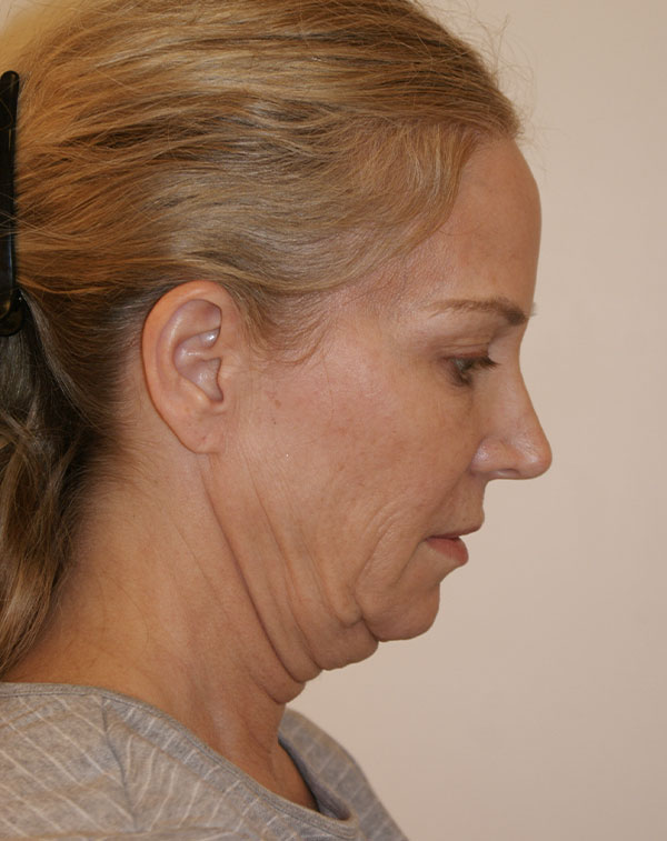 Photo of Patient 22 Before Face And Neck Lift Procedure