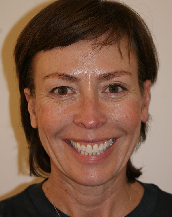 Photo of Patient 23 Before Face And Neck Lift Procedure