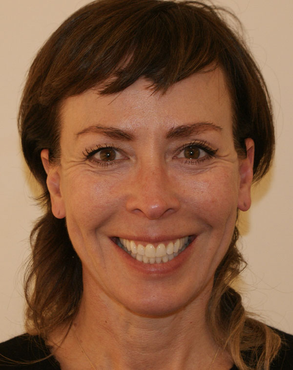 Photo of Patient 23 After Face And Neck Lift Procedure