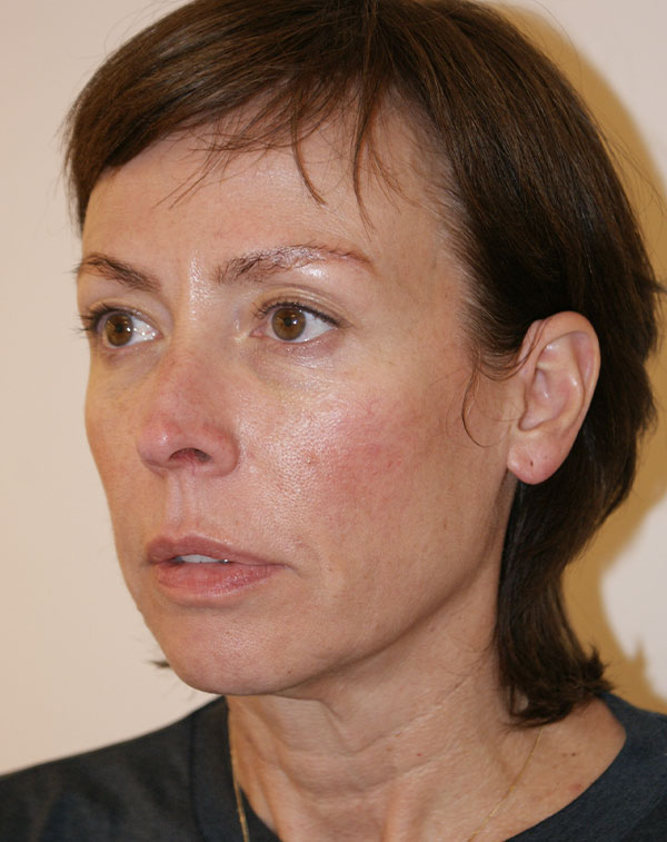 Photo of Patient 23 Before Face And Neck Lift Procedure