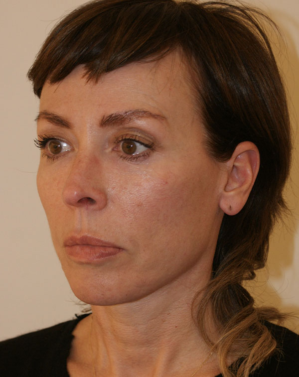 Photo of Patient 23 After Face And Neck Lift Procedure