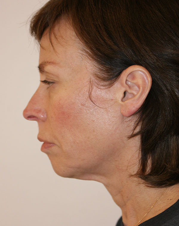 Photo of Patient 23 Before Face And Neck Lift Procedure