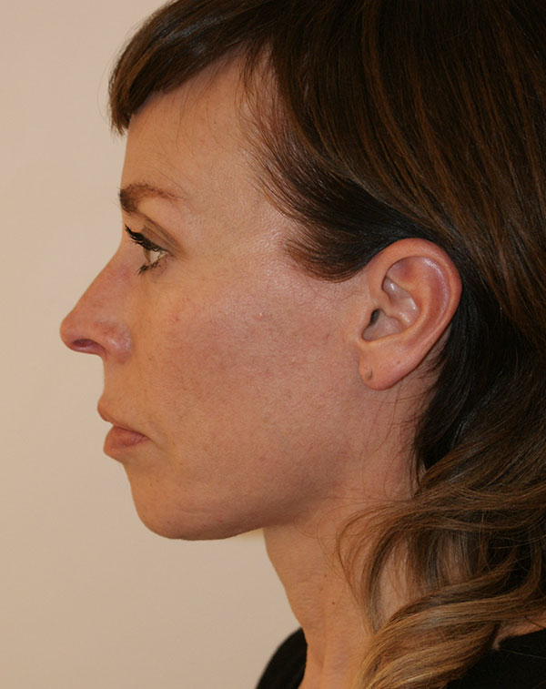 Photo of Patient 23 After Face And Neck Lift Procedure
