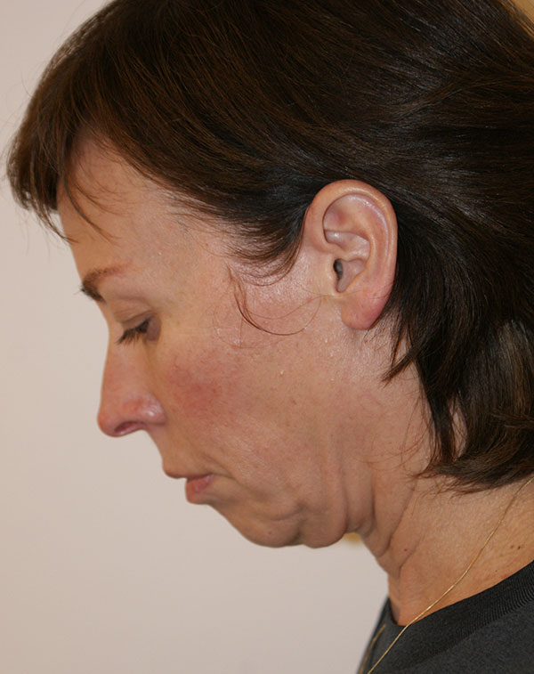 Photo of Patient 23 Before Face And Neck Lift Procedure