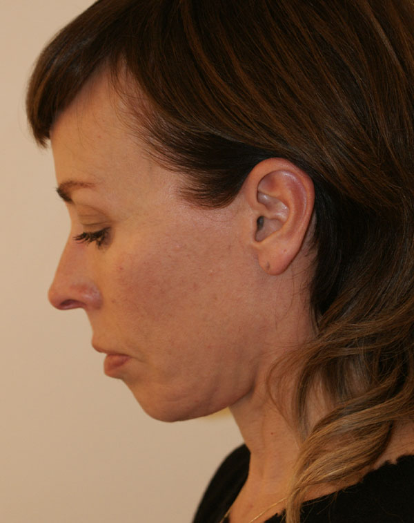Photo of Patient 23 After Face And Neck Lift Procedure