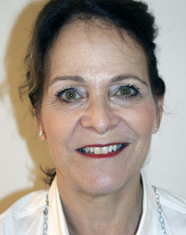 Photo of Patient 24 Before Face And Neck Lift Procedure