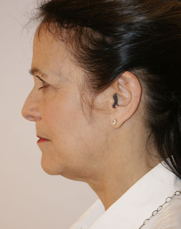 Photo of Patient 24 Before Face And Neck Lift Procedure