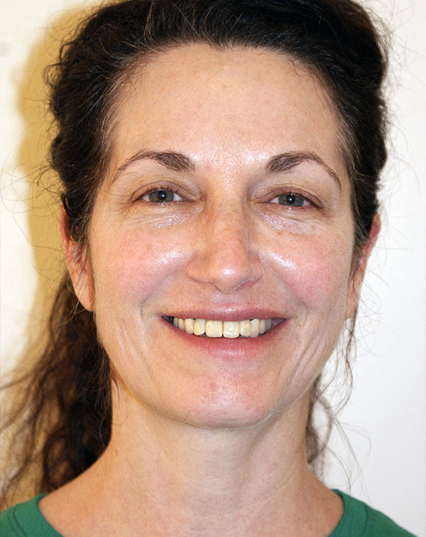 Photo of Patient 25 Before Face And Neck Lift Procedure