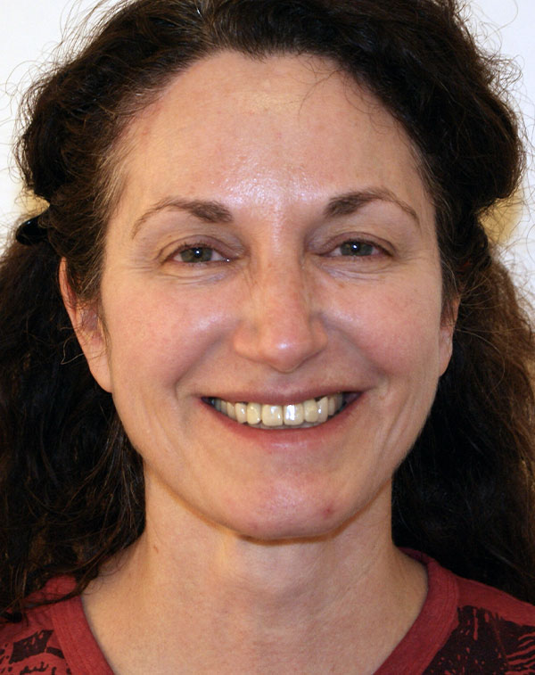 Photo of Patient 25 After Face And Neck Lift Procedure